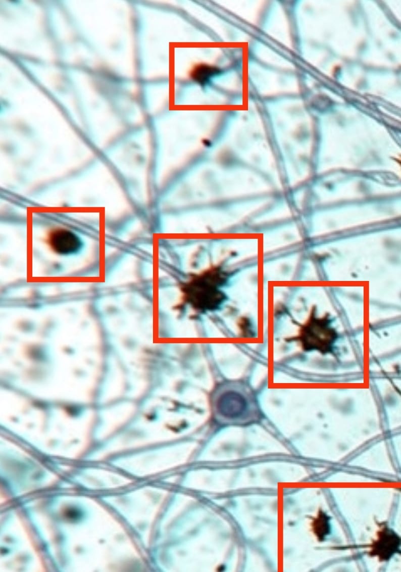 New Alzheimer's treatments do not alter amyloid plaque detection by brain imaging